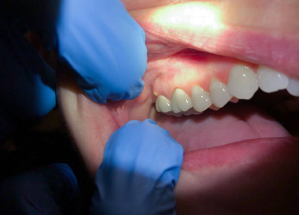 Best Emergency Tooth Extraction in Bonny Doon, CA