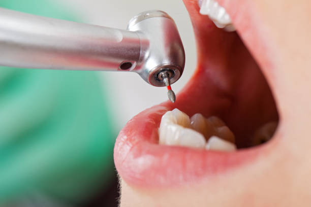 Best Emergency Treatment for Dental Infections or Abscesses in Bonny Doon, CA